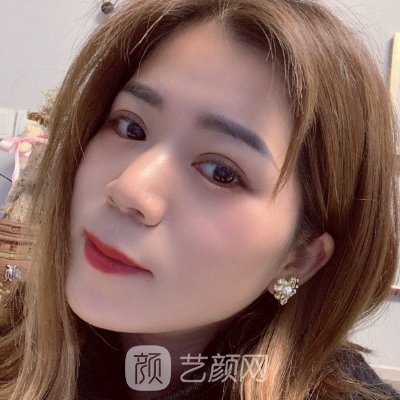 杭州格莱美是正规医院吗?60天双眼皮整形实例展示